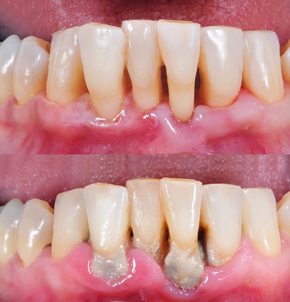 Before and after photo of cleaning human teeth with periodontitis.